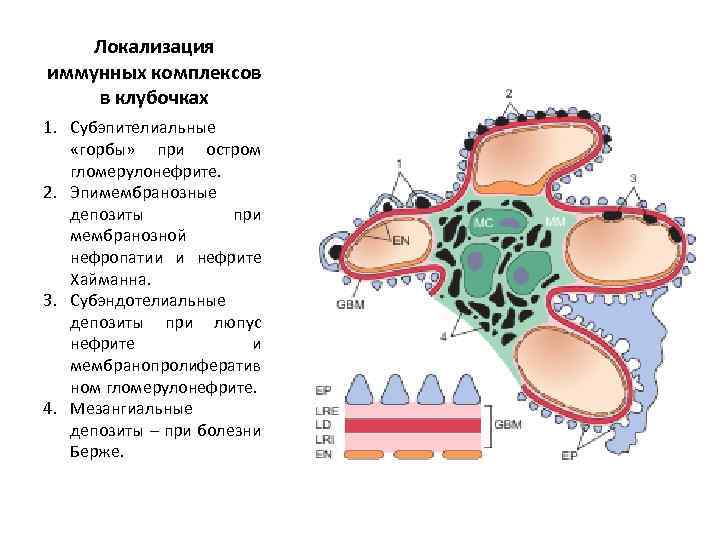 Локализация иммунных комплексов в клубочках 1. Субэпителиальные «горбы» при остром гломерулонефрите. 2. Эпимембранозные депозиты