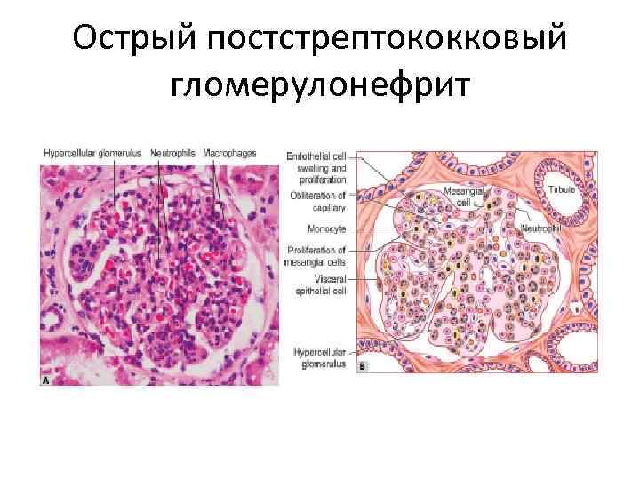 Острый постстрептококковый гломерулонефрит 