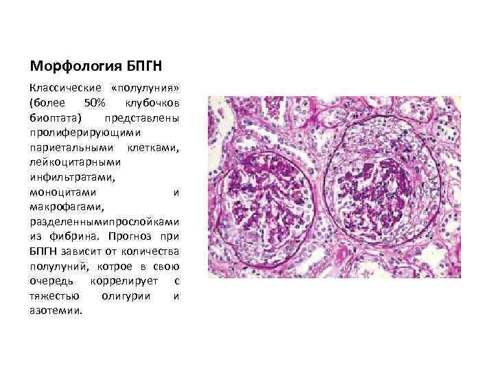 Морфология БПГН Классические «полулуния» (более 50% клубочков биоптата) представлены пролиферирующими париетальными клетками, лейкоцитарными инфильтратами,