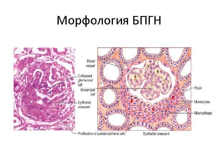 Морфология БПГН 