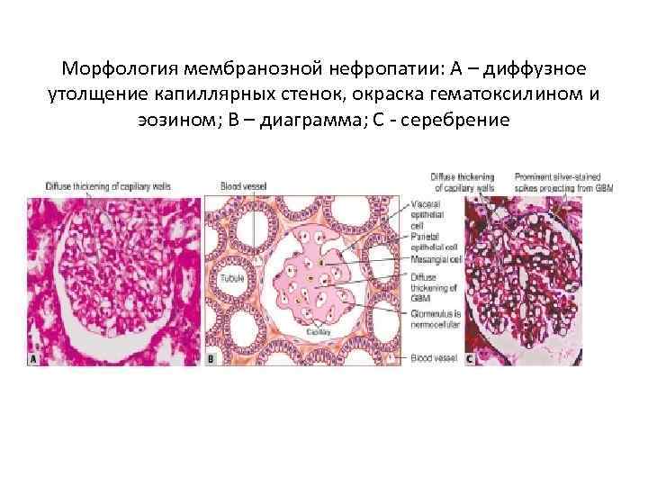 Морфология мембранозной нефропатии: А – диффузное утолщение капиллярных стенок, окраска гематоксилином и эозином; B