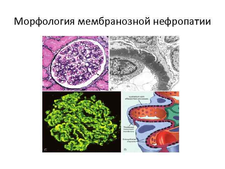 Морфология мембранозной нефропатии 