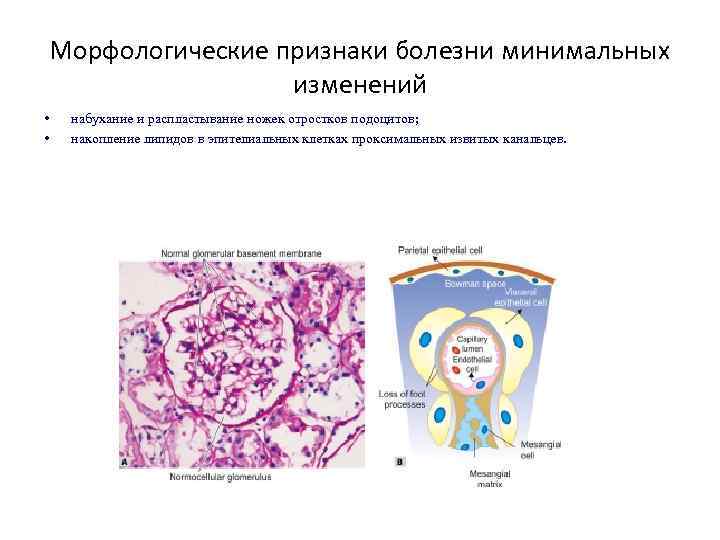 Морфологические признаки болезни минимальных изменений • • набухание и распластывание ножек отростков подоцитов; накопление