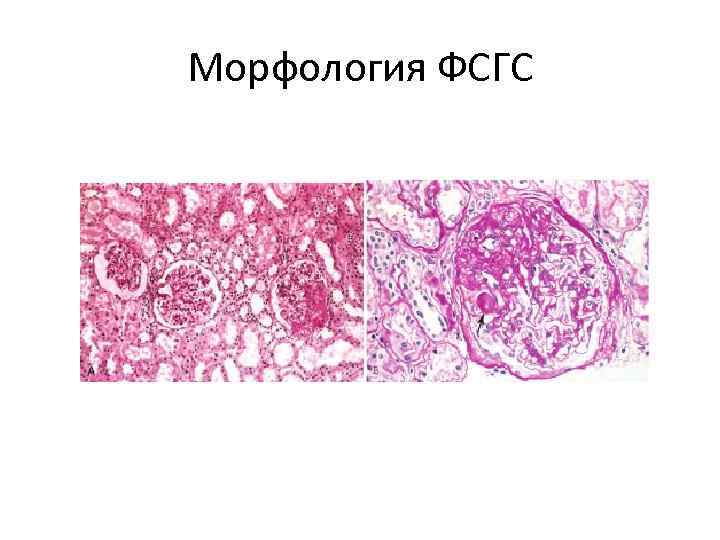 Морфология ФСГС 