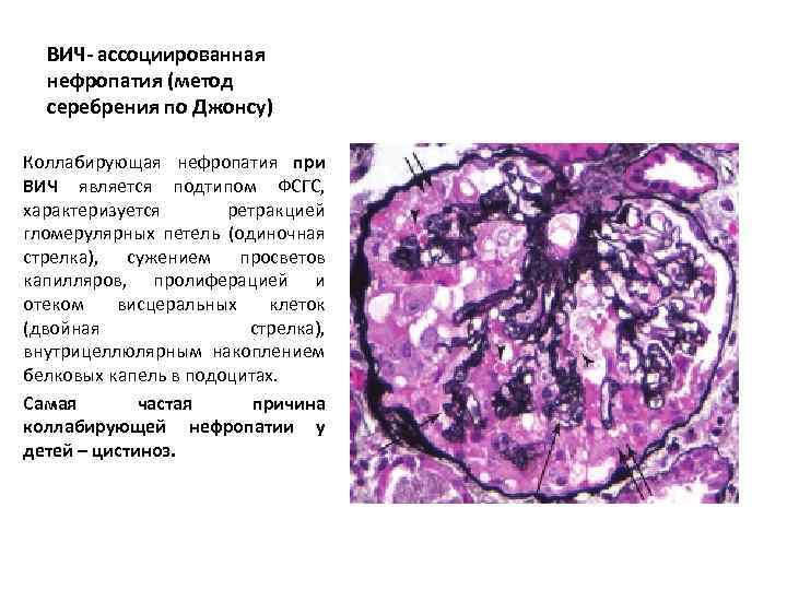 ВИЧ- ассоциированная нефропатия (метод серебрения по Джонсу) Коллабирующая нефропатия при ВИЧ является подтипом ФСГС,