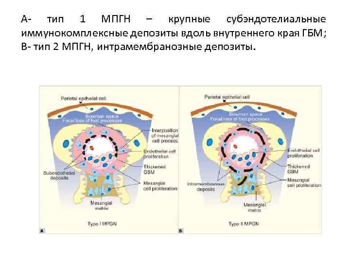 А- тип 1 МПГН – крупные субэндотелиальные иммунокомплексные депозиты вдоль внутреннего края ГБМ; В-