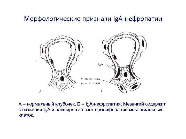 Морфологические признаки Ig. A-нефропатии А – нормальный клубочек. Б – Ig. A-нефропатия. Мезангий содержит