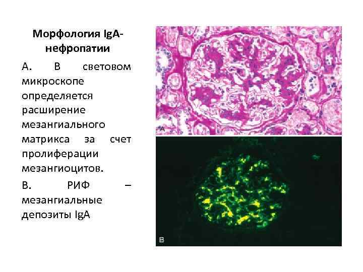 Морфология Ig. Aнефропатии А. В световом микроскопе определяется расширение мезангиального матрикса за счет пролиферации