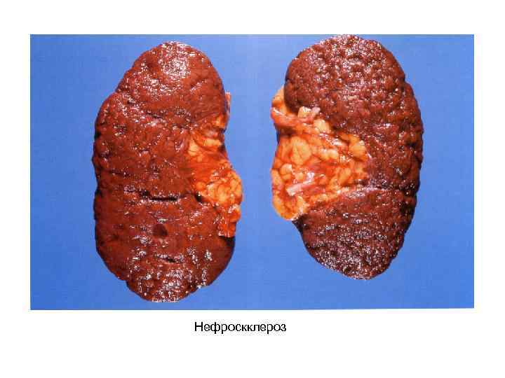 Нефроскклероз 