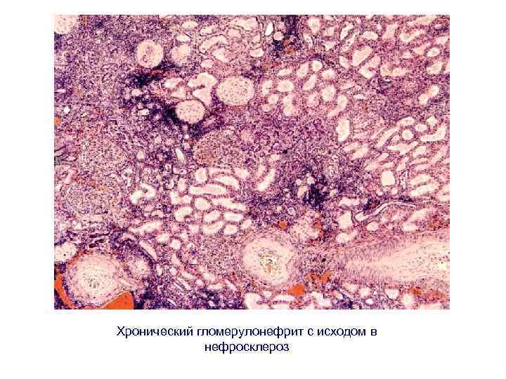 Хронический гломерулонефрит с исходом в нефросклероз 