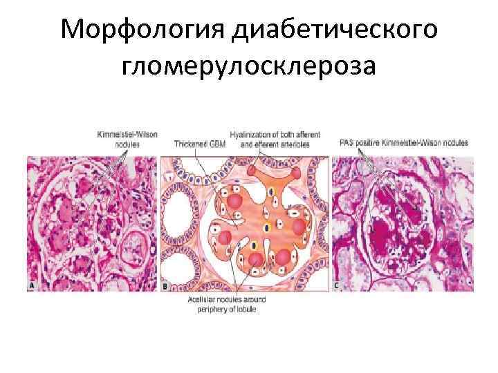 Морфология диабетического гломерулосклероза 