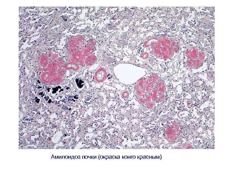 Амилоидоз почки (окраска конго красным) 