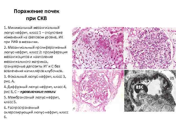 Поражение почек при СКВ 1. Минимальный мезангиальный люпус-нефрит, класс 1 – отсутствие изменений на