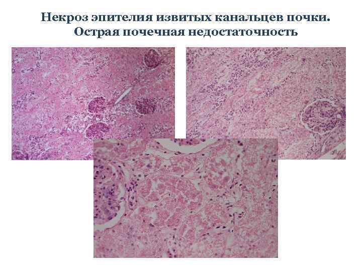 Некроз эпителия извитых канальцев почки. Острая почечная недостаточность 