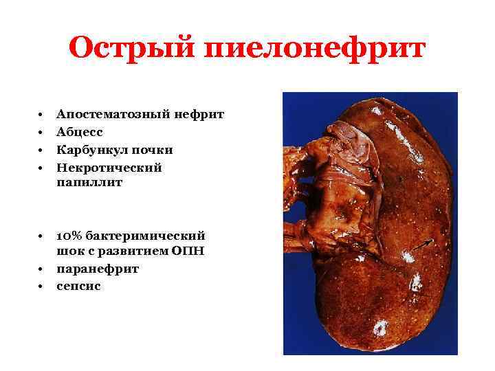 Злокачественный нефросклероз фара