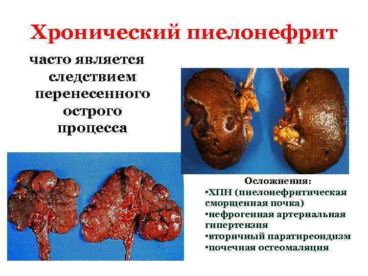Хронический пиелонефрит часто является следствием перенесенного острого процесса Осложнения: • ХПН (пиелонефритическая сморщенная почка)