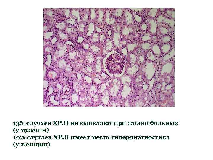 13% случаев ХР. П не выявляют при жизни больных (у мужчин) 10% случаев ХР.