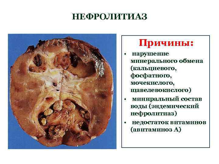 НЕФРОЛИТИАЗ Причины: • нарушение минерального обмена (кальциевого, фосфатного, мочекислого, щавелевокислого) • миниральный состав воды