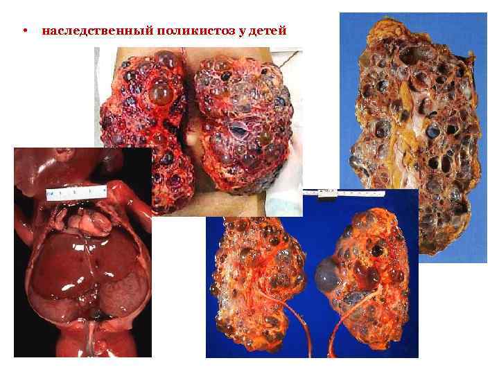  • наследственный поликистоз у детей 