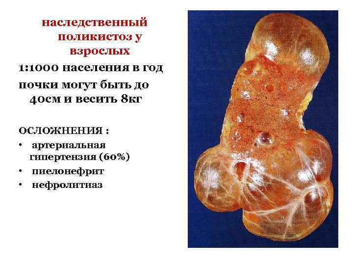 наследственный поликистоз у взрослых 1: 1000 населения в год почки могут быть до 40