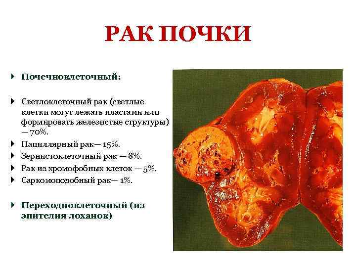 РАК ПОЧКИ Почечноклеточный: Светлоклеточный рак (светлые клетки могут лежать пластами или формировать железистые структуры)