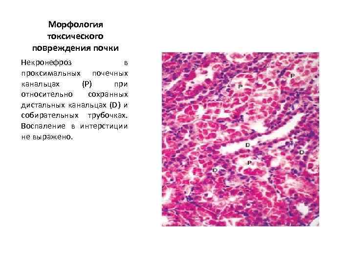 Токсическая нефропатия презентация