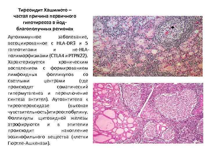 Тиреоидит хашимото презентация