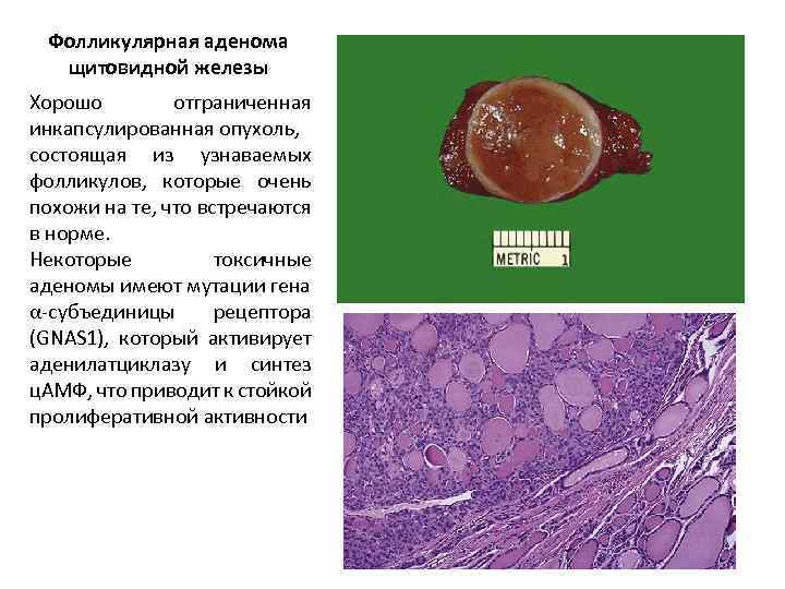 Фолликулярная аденома щитовидной железы Хорошо отграниченная инкапсулированная опухоль, состоящая из узнаваемых фолликулов, которые очень