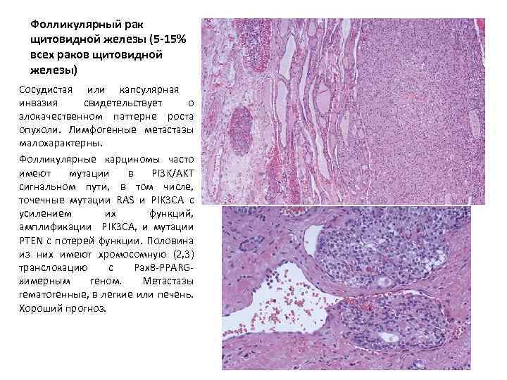Цитологическая картина фолликулярной опухоли щитовидной железы что значит