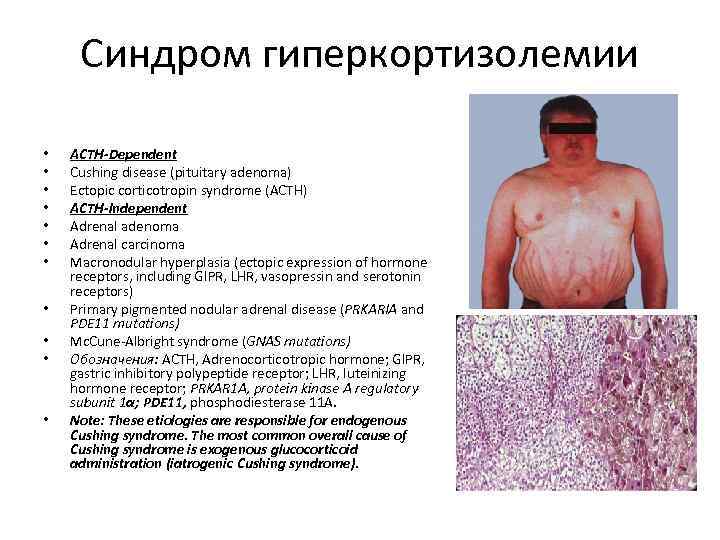 Синдром гиперкортизолемии • • • ACTH-Dependent Cushing disease (pituitary adenoma) Ectopic corticotropin syndrome (ACTH)