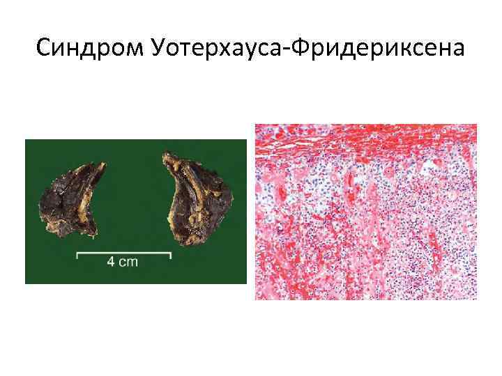 Синдром уотерхауса фридериксена презентация