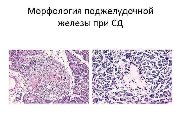 Морфология поджелудочной железы при СД 