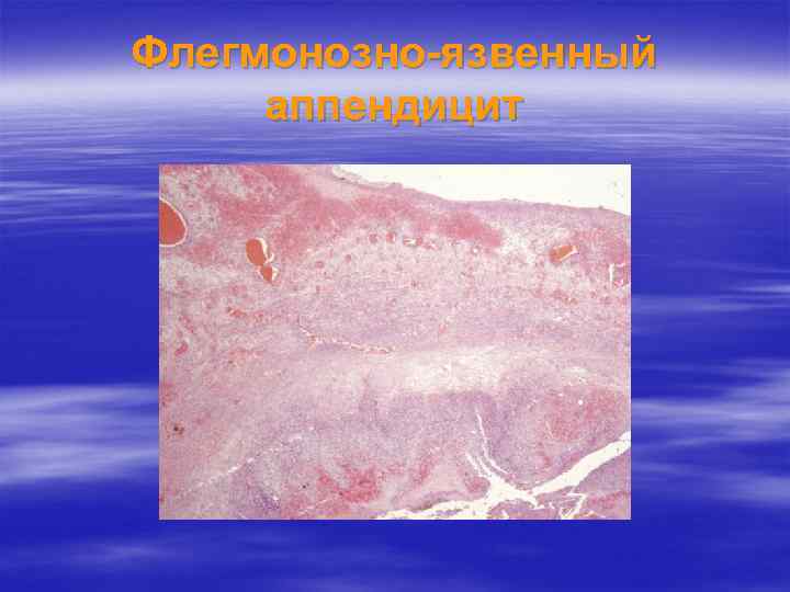 Флегмонозно-язвенный аппендицит 