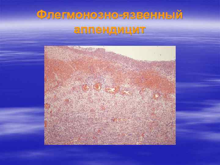Флегмонозно-язвенный аппендицит 