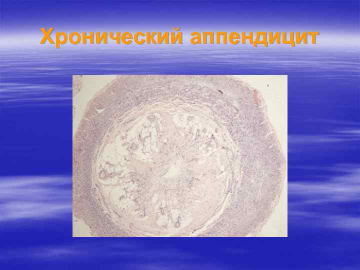 Хронический аппендицит 