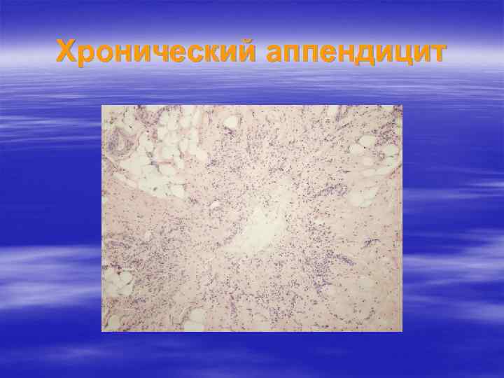 Хронический аппендицит 