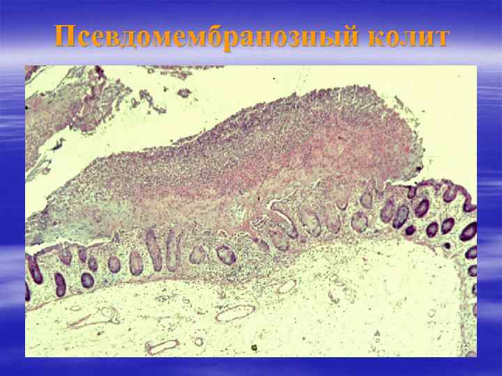 Псевдомембранозный колит 