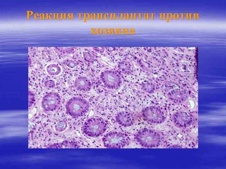 Реакция трансплантат против хозяина 