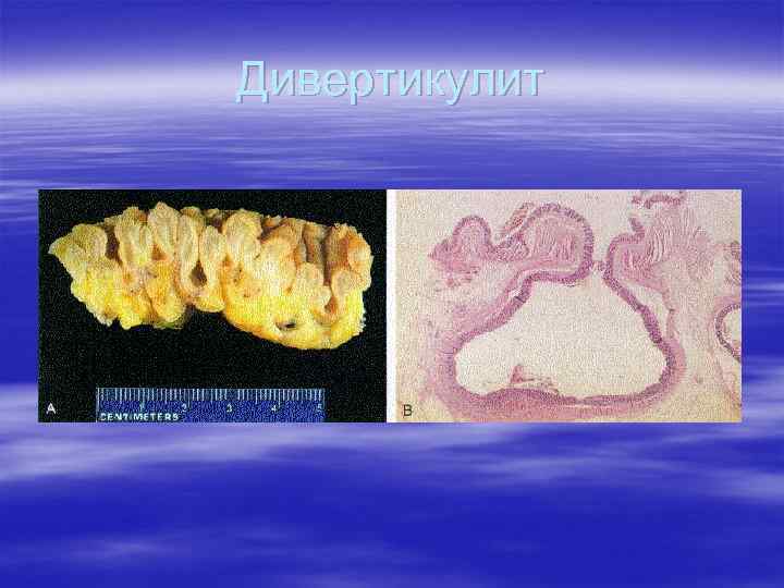 Дивертикулит 