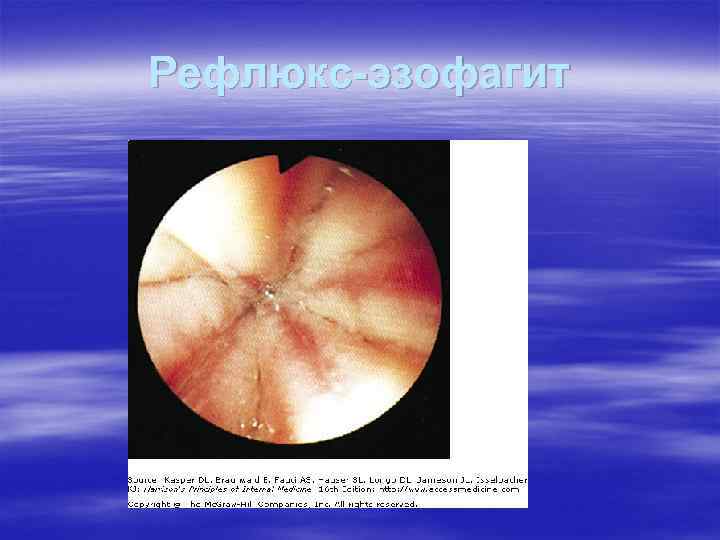 Рефлюкс-эзофагит 