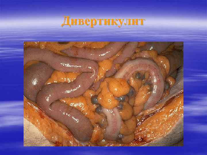 Дивертикулит 
