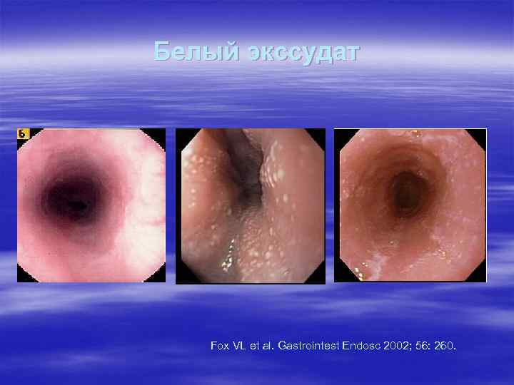 Белый экссудат Fox VL et al. Gastrointest Endosc 2002; 56: 260. 