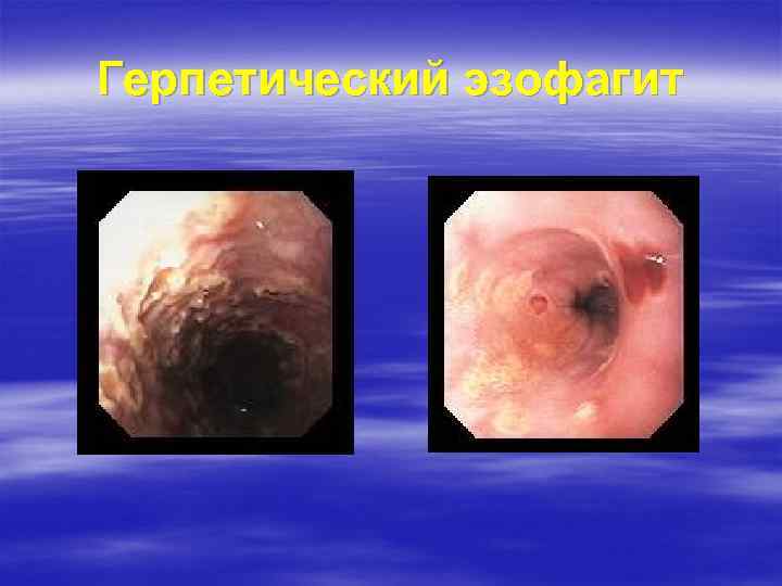 Герпетический эзофагит 