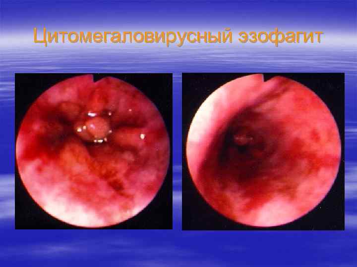 Цитомегаловирусный эзофагит 