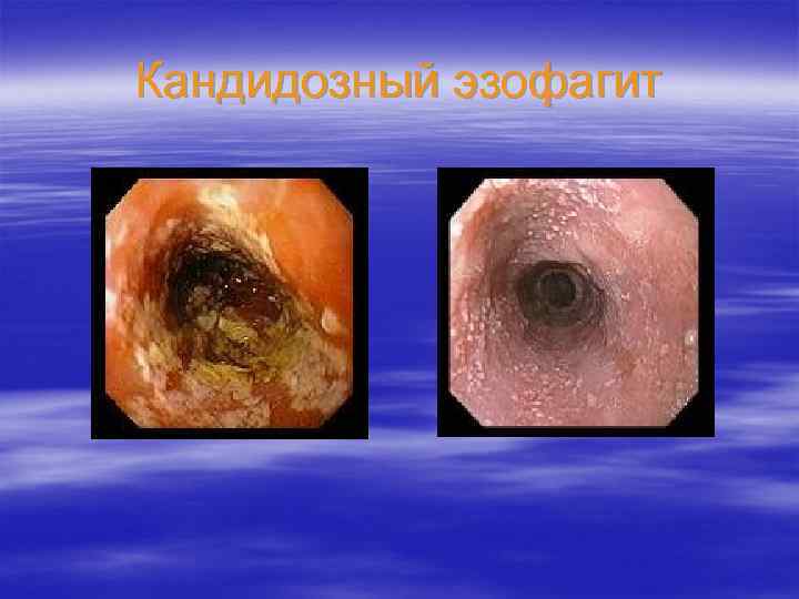 Кандидозный эзофагит 