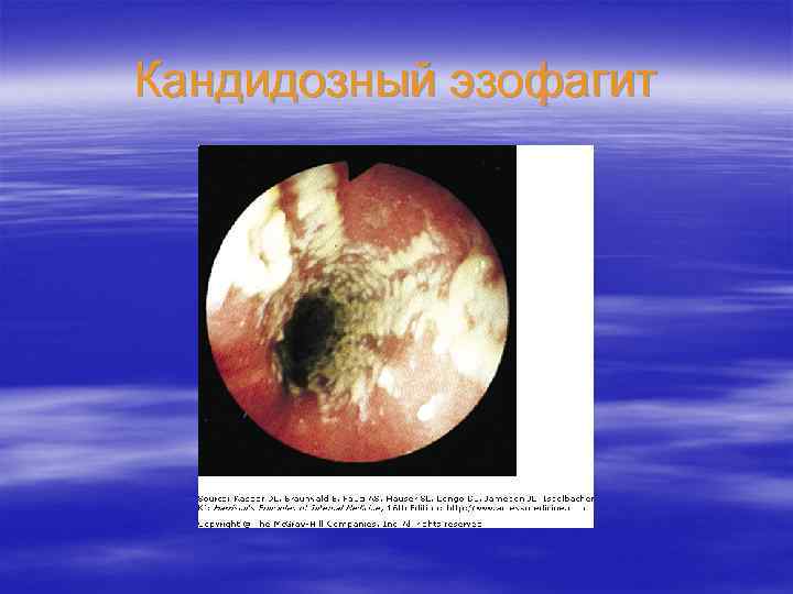 Кандидозный эзофагит 