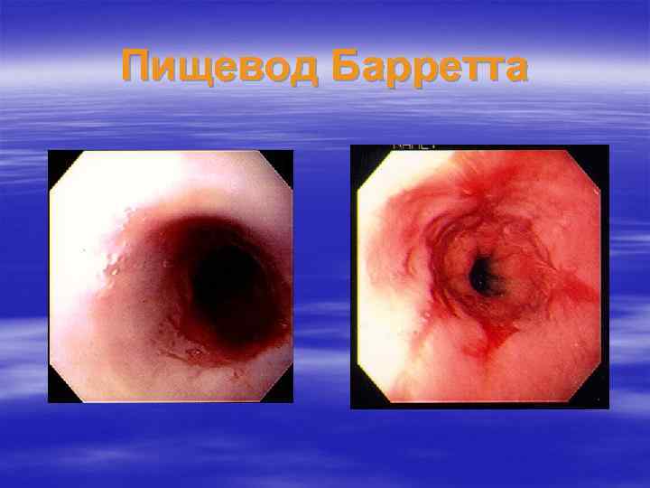 Пищевод Барретта 