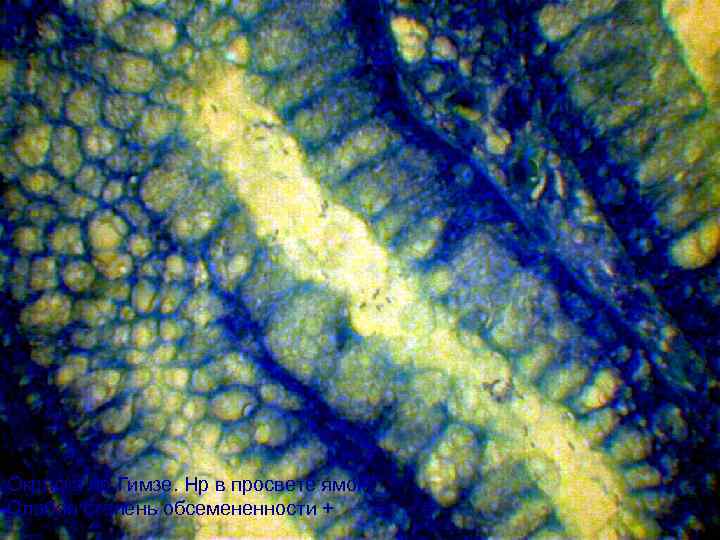 Окраска по Гимзе. Нр в просвете ямок. Слабая степень обсемененности + 