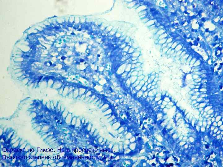 Окраска по Гимзе. Нр в просвете ямок. Высокая степень обсемененности +++ 