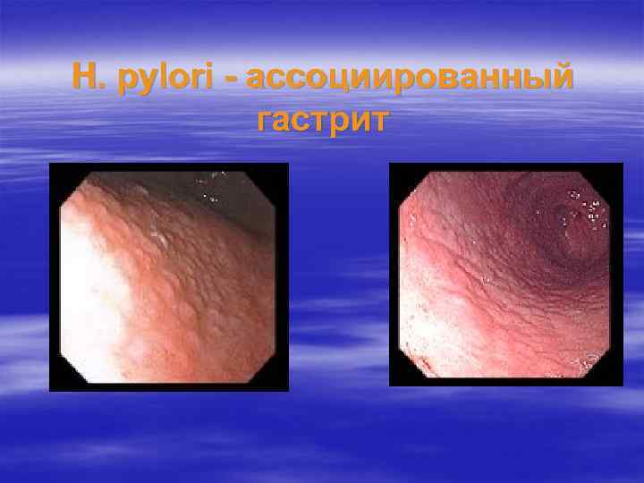 H. pylori - ассоциированный гастрит 